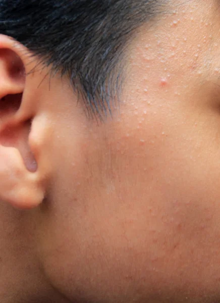 Ragazzo con pelle grassa e cicatrici da acne — Foto Stock