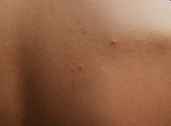 Jongen met problematische huid en acne littekens in de rug — Stockfoto