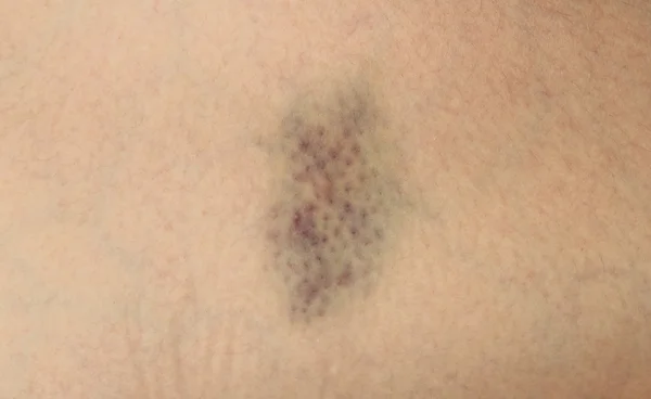 Closeup Hematomas na pele da perna da mulher ferida — Fotografia de Stock
