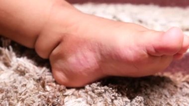  Çocuk kaşıntıdan muzdarip, yakından..