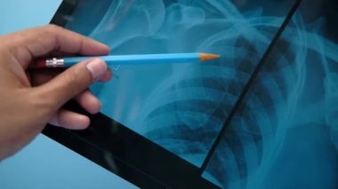 Doktor beklemede. Röntgen fotoğrafçılığı analiz ediliyor. Yakın plan.