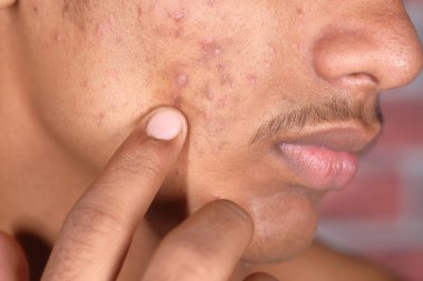 Dermatoloji sorunu olan genç bir çocuğa yakın durun. 