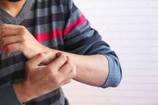 Young mans hand suffering from itching skin — Stock Photo, Image