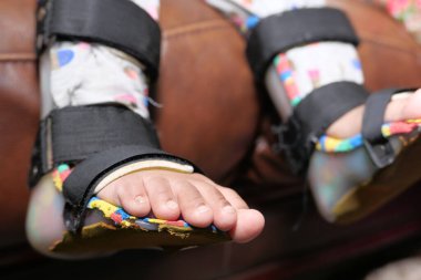 Çocuk serebral felç, bacak ortozu..