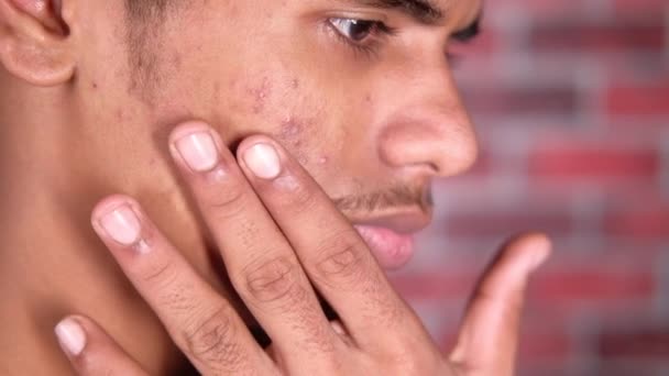 Zblízka mladého muže tvář s kožním problémem . — Stock video