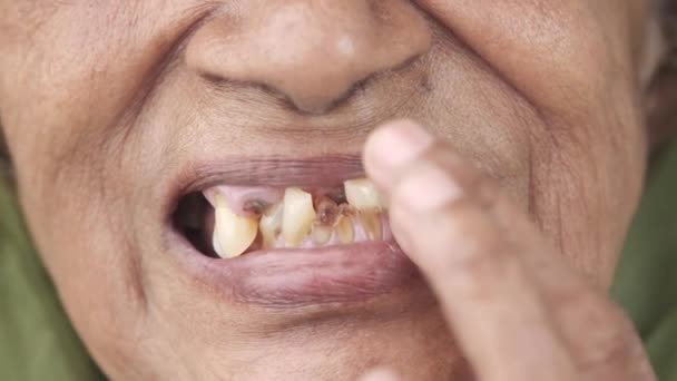Lähikuva vanhempi naisten hampaiden karieksen ja joitakin rikki hampaat — kuvapankkivideo