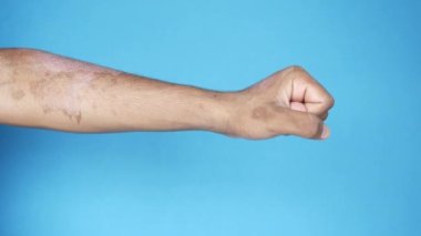 Mavi arka planda insan eli yanıkları .