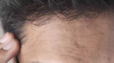 Saç dökülmesi konsepti. 