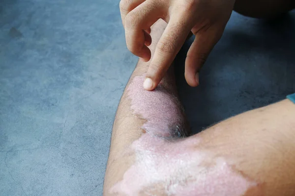 Burns on man hand on black background . — Stock Photo, Image