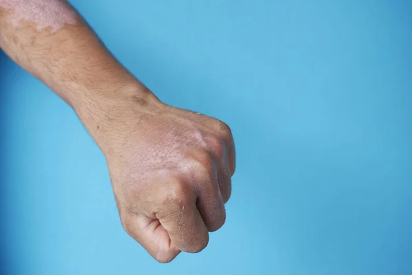 Quemaduras en la mano del hombre sobre fondo azul . — Foto de Stock