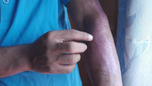 Jonge man tonen brandwonden op de hand close-up — Stockvideo