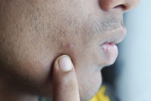 Close up of young man face with skin problem . — Stock Photo, Image