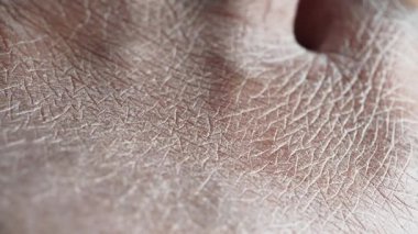 Ayrıntılı kuru desenli cildin yakın plan görüntüsü.