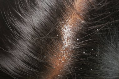 Flakes of dandruff are noticeable on a persons dark hair and scalp.