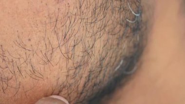 Bölgeyi işaret eden bir parmak ile ciltteki saç çıkıntısına yakından bakın..