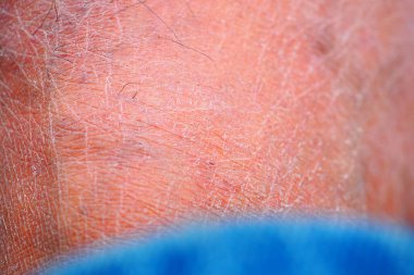 Kuru cilt dokusu kapat .