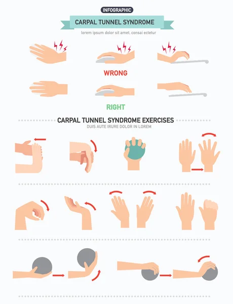 Infografía del síndrome del túnel carpiano — Archivo Imágenes Vectoriales