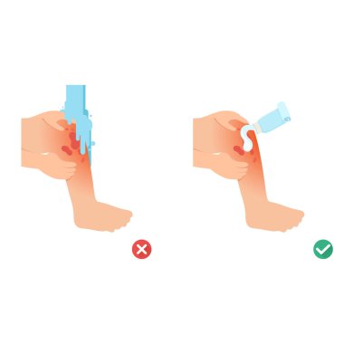 yanlış ve doğru cilt ilk yardım yanığı