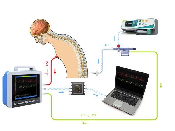 Poster Medico Con Puntura Lombare Procedura Del Rubinetto Spinale Con — Foto Stock