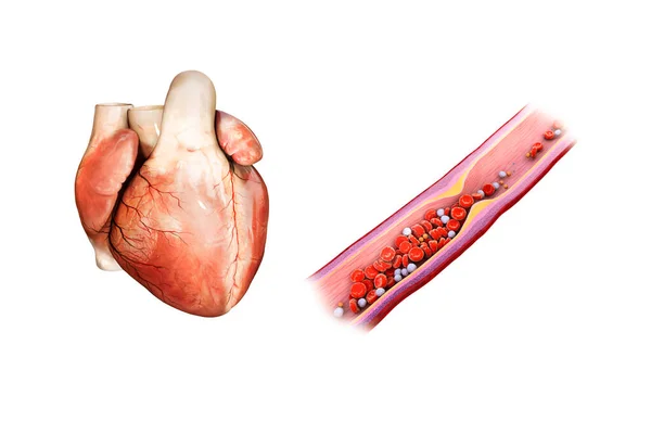 心臓発作 アテローム性動脈硬化症 動脈のコレステロールプラークフォーム 血栓フォームと動脈ブロック イラスト — ストック写真