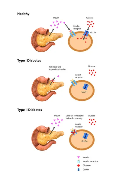 Ação Insulina Diabetes Tipo Gráfico Renderização Ilustração — Fotografia de Stock
