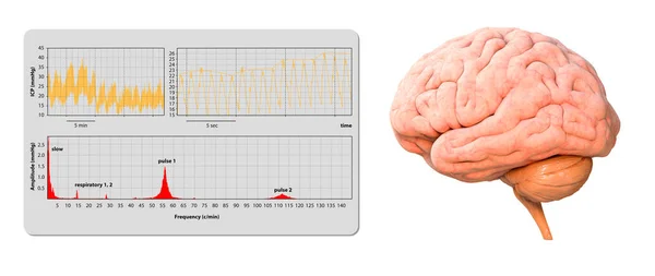 Intracranial Pressure Monitoring Icp Waveform Render Graphic Illustration — Stock Photo, Image