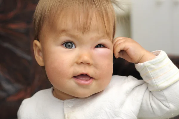 Baby with a swollen eye from an insect bite — Stock Photo, Image