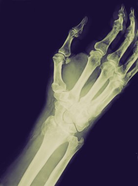 Retro görünüm xray perma ile azaltılmış epiphysial Radyal kırık