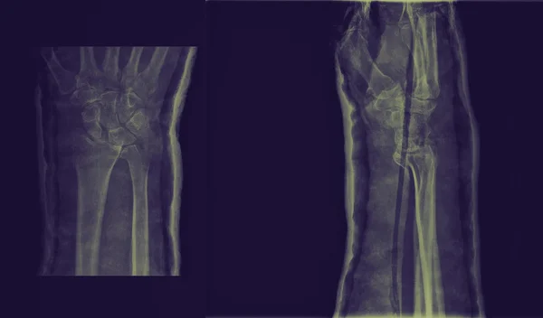 Retro look Xray of epiphysial radial fracture reduced with perma — Stock Photo, Image