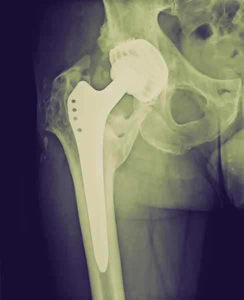 Retro look Permanent total hip arthroplasty xray — Stock Photo, Image