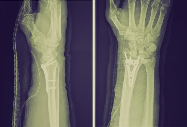 Retro look Xray of epiphysial radial fracture reduced with perma — Stock Photo, Image