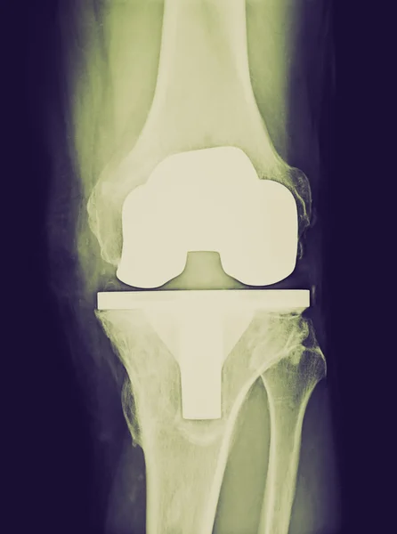 Retro look Bicompartmental knee prosthesis xray — Stock Photo, Image