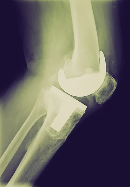 Retro look Bicompartmental knee prosthesis xray — Stock Photo, Image