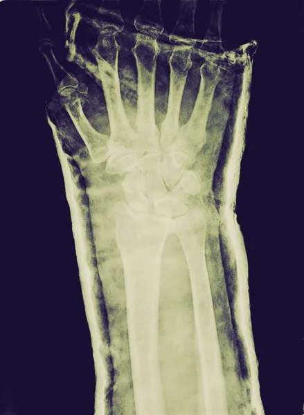 Retro look Xray of epiphysial radial fracture reduced with perma — Stock Photo, Image