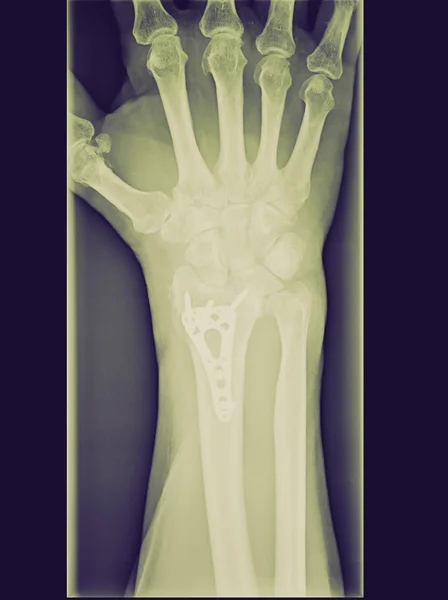 Ретро-взгляд Рентген эпифизического лучевого перелома, уменьшенный с вечностью — стоковое фото