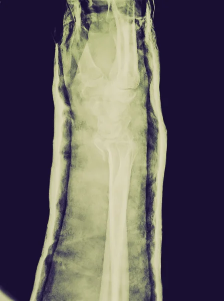 Ретро-взгляд Рентген эпифизического лучевого перелома, уменьшенный с вечностью — стоковое фото