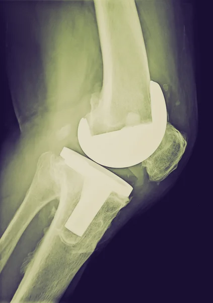Retro vzhled bicompartmental kolenní protéza xray — Stock fotografie