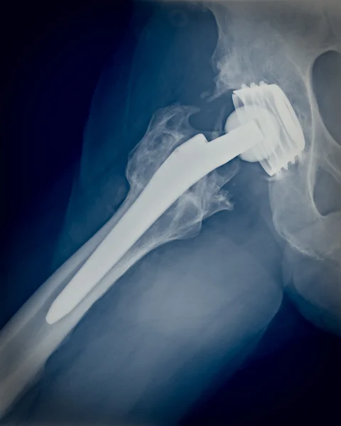 Permanent total hip arthroplasty xray — Stock Photo, Image