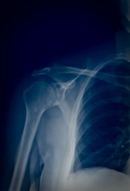 Xray