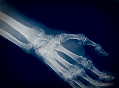 Xray