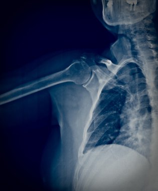 Xray