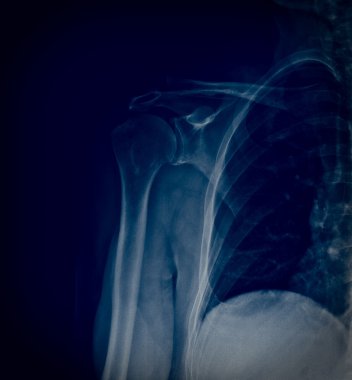 Xray