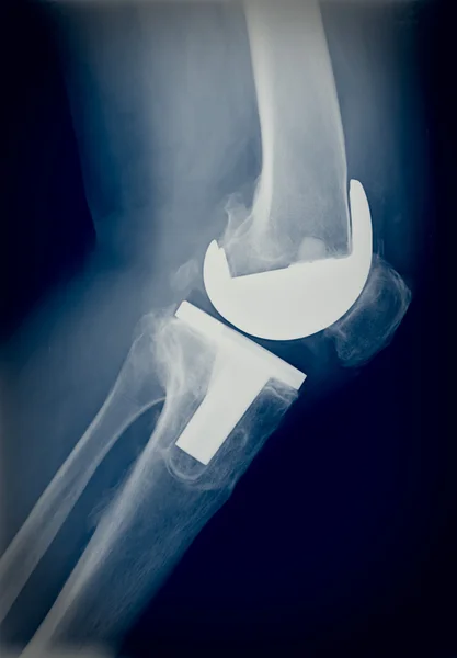Bicompartmental kolana protezy xray — Zdjęcie stockowe