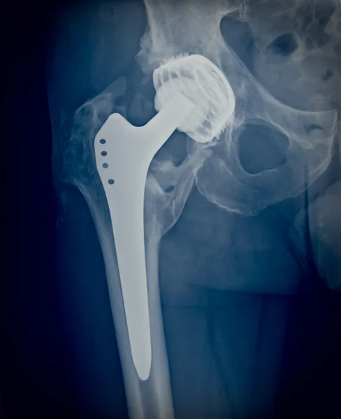 Permanent total hip arthroplasty xray — Stock Photo, Image