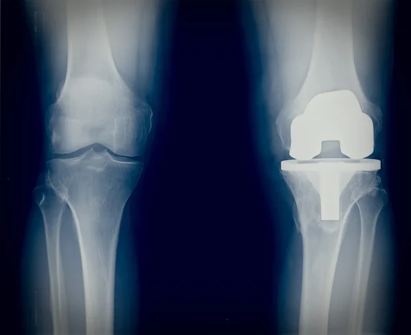 Bicompartmental knee prosthesis xray — Stock Photo, Image