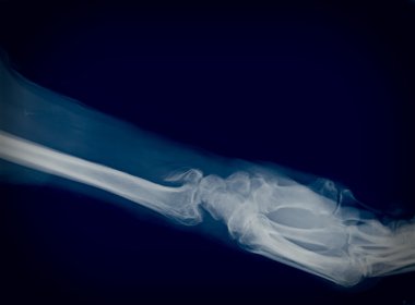 Xray
