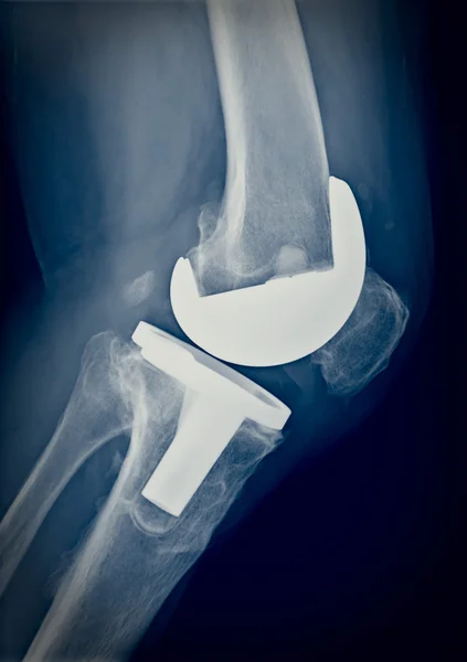 Bicompartmental knee prosthesis xray — Stock Photo, Image