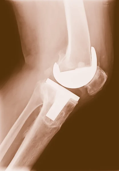 Bicompartmental knee prosthesis xray — Stock Photo, Image