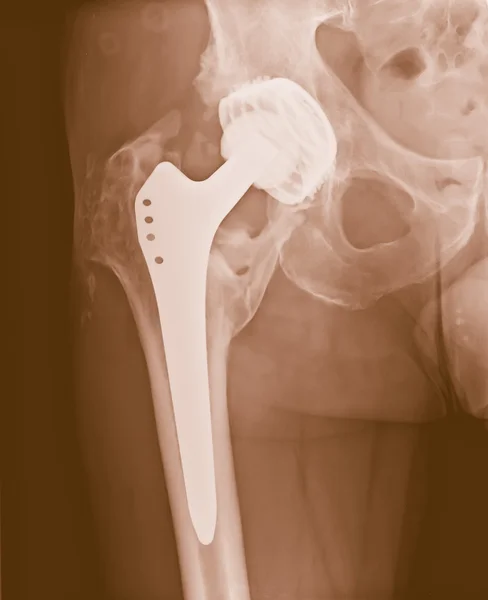 Permanent total hip arthroplasty xray — Stock Photo, Image