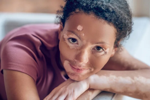 Mulher jovem bonito com pigmentação em seu rosto olhar sincero e doce — Fotografia de Stock